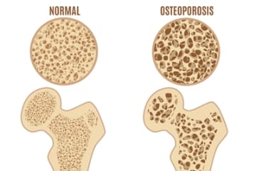 Do Men Get Osteoporosis?