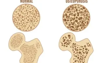 Do Men Get Osteoporosis?